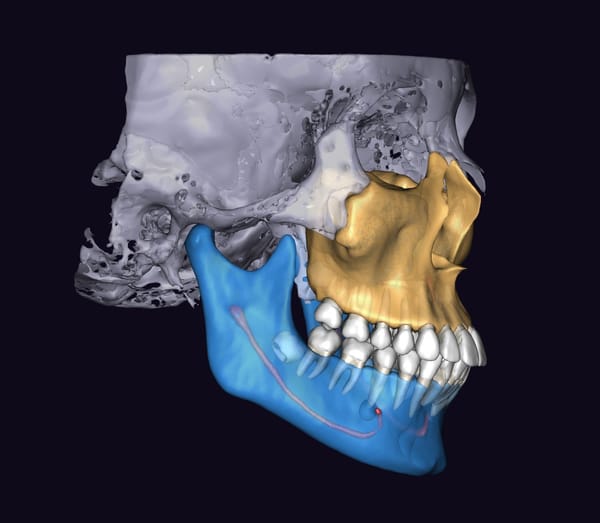 Tomographie 3D des deux mâchoires avec ATM
