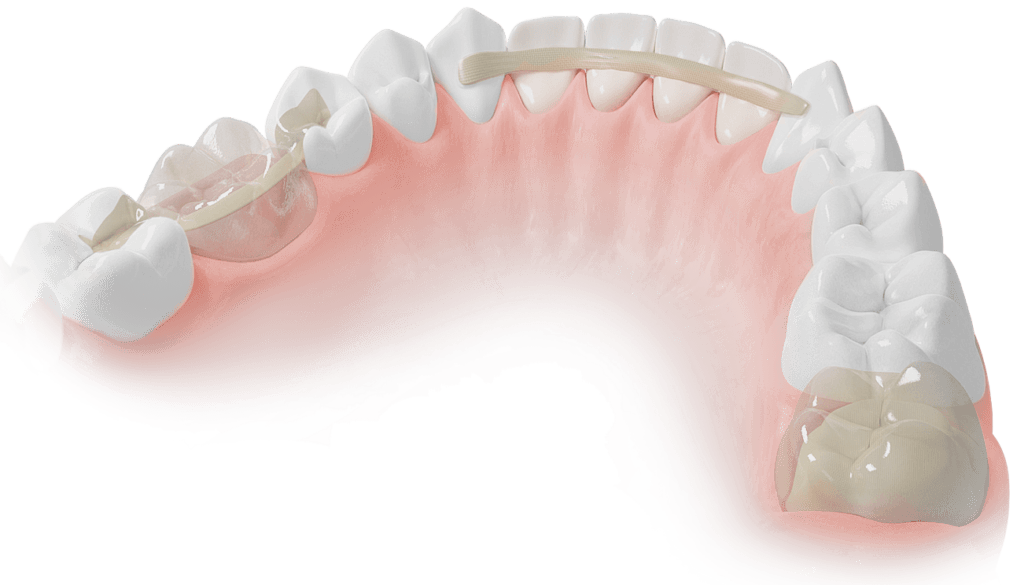 ADM Dentapreg & Fibrafill