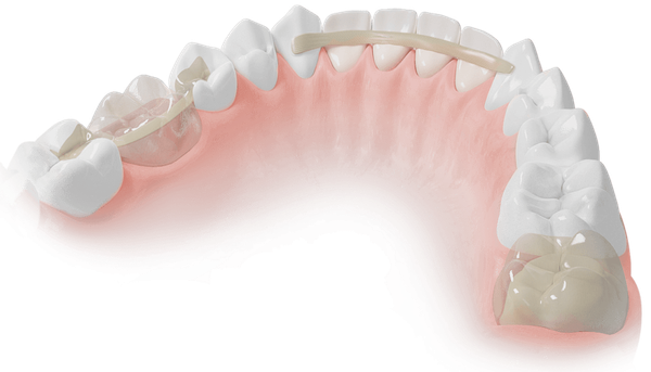 ADM Dentapreg & Fibrafill