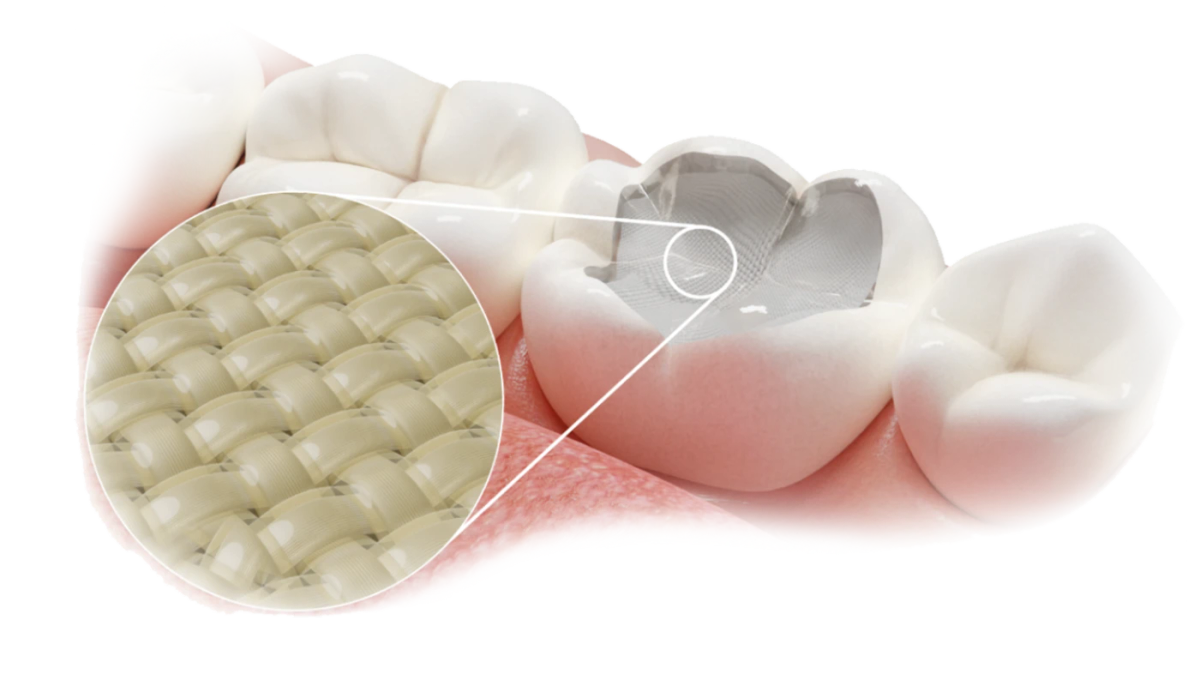 Fibrafill – ADM (ADM Dental), Composites