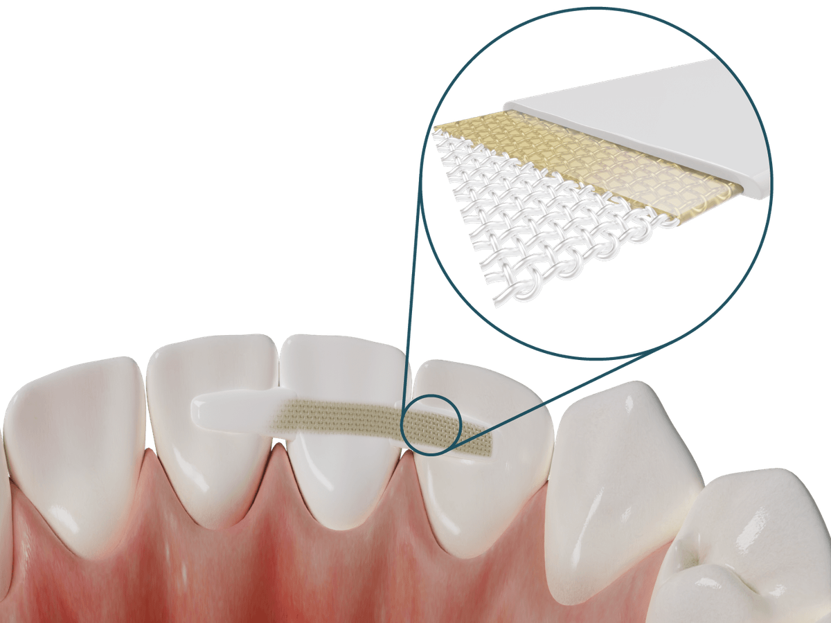 Dentapreg® PFM – ADM Dentapreg & Fibrafill, Temporary Crowns