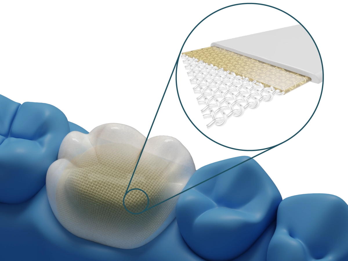 Dentapreg® VEIL – ADM Dentapreg & Fibrafill, Composites