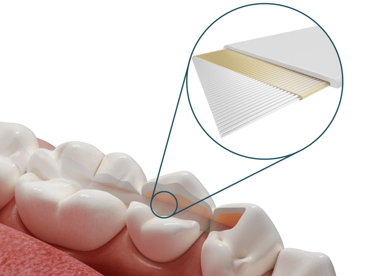 Dentapreg® SFU – Dentapreg - ADM, a.s, Other Splints
