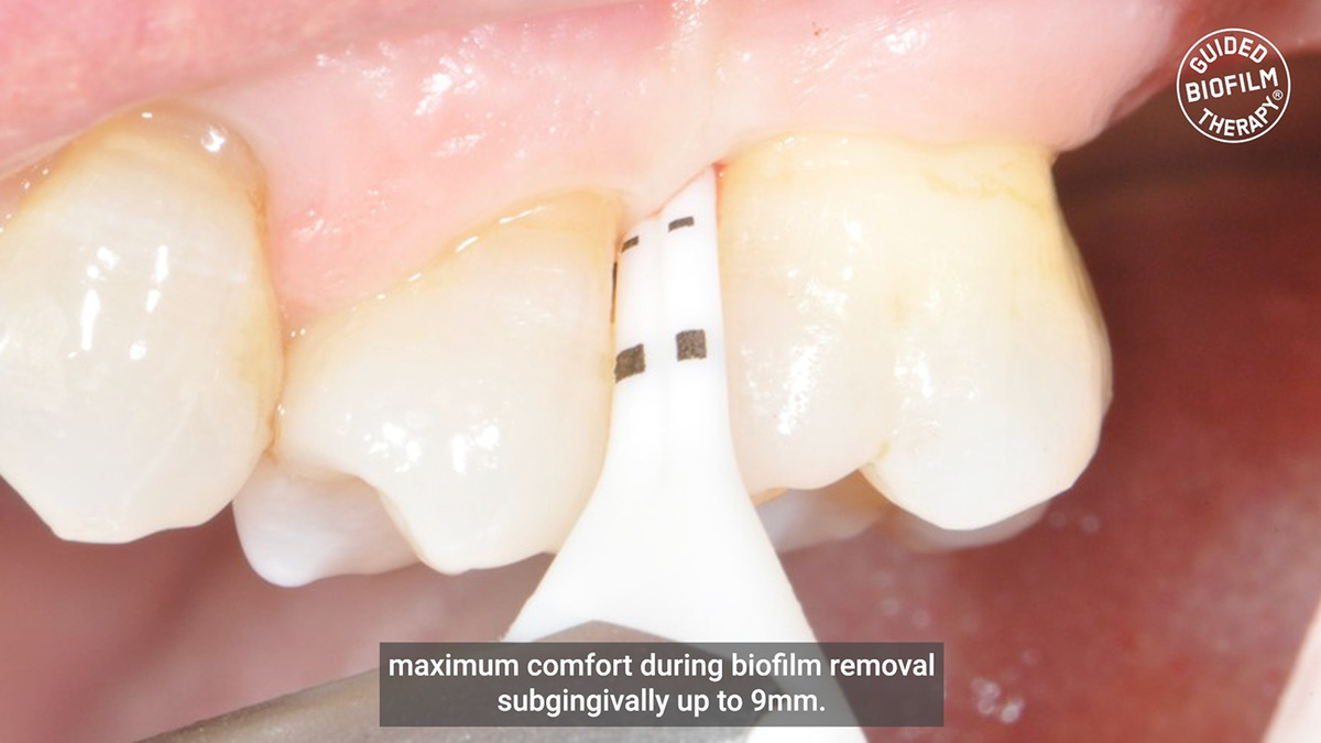 PERIOFLOW® MAX – EMS Electro Medical Systems, Periodontal Surgery