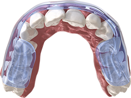 Aqualizer® Dental Splints