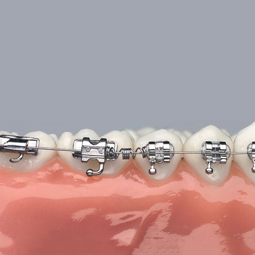 DYNAFLEX NICKEL TITANIUM DISTALIZING SPRING – Dynaflex Orthodontics USA, Drähte und Bögen