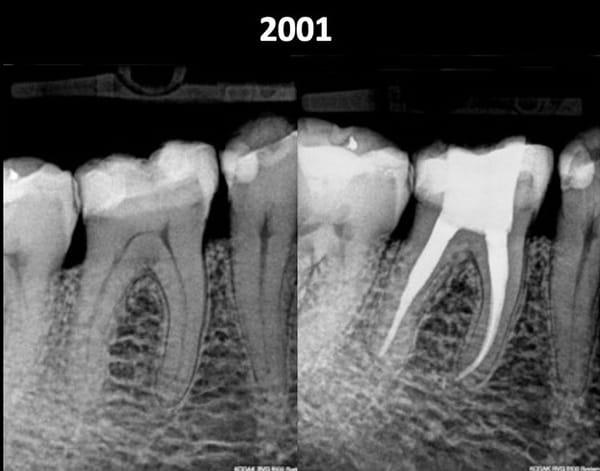 Bassi Endodontic Files