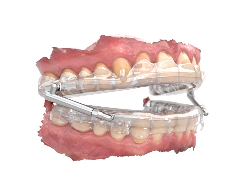 BioBiteCorrector® Sleep Appliance – BBC-Orthotec GmbH, Intraoral Appliances