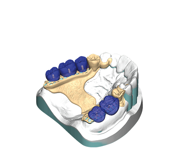 PartialCAD – Exocad