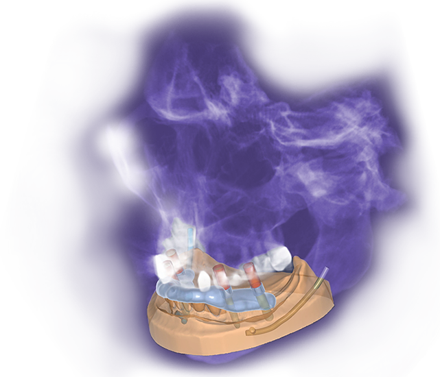 exoplan – Exocad, CAD/CAM Software