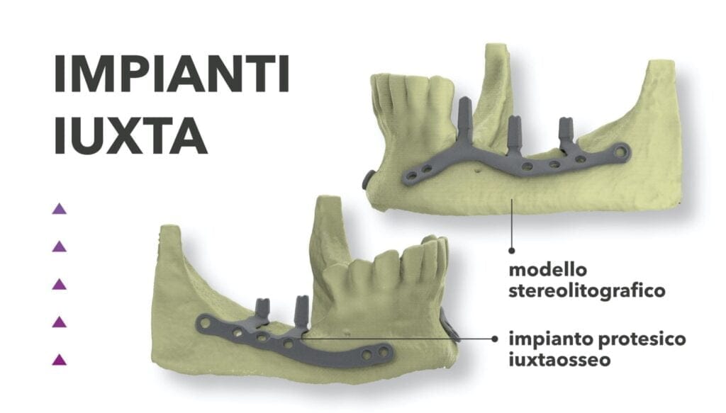Impianti IUXTA Subperiostali – B&B Dental SRL, Implants