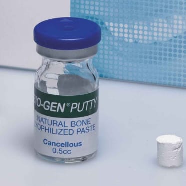 Biomateriali per rigenerazione ossea – Putty
