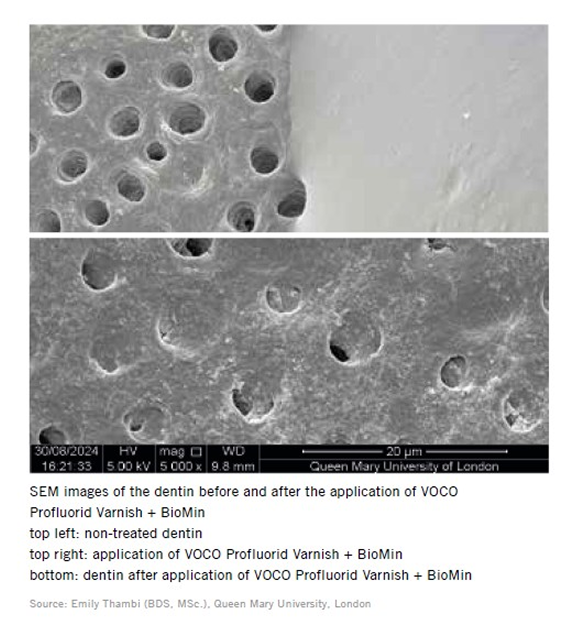 VOCO Profluorid Varnish + BioMin