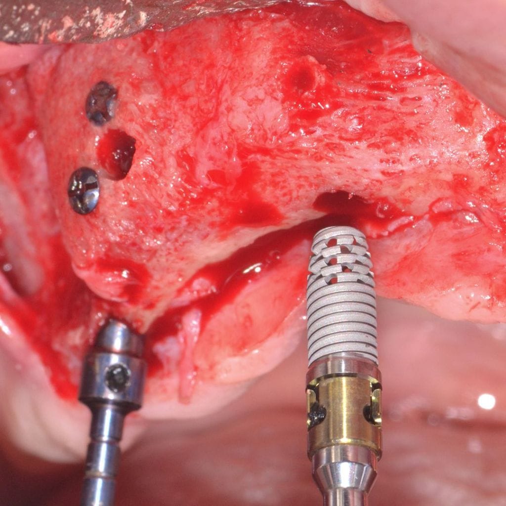 Bloque poroso de relleno óseo – Bionnovation Biomedical, Bone Graft Materials