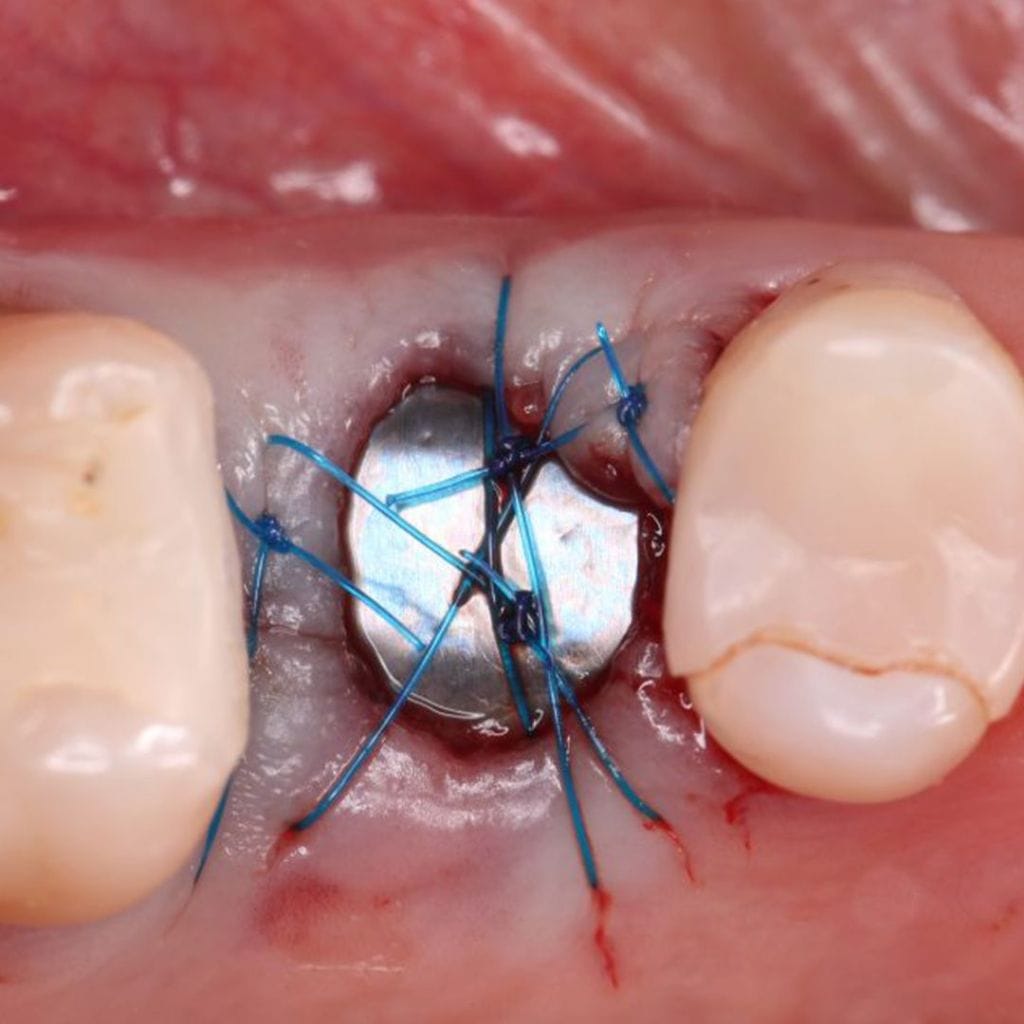 Sello Surgitime – Bionnovation Biomedical, Implantologie