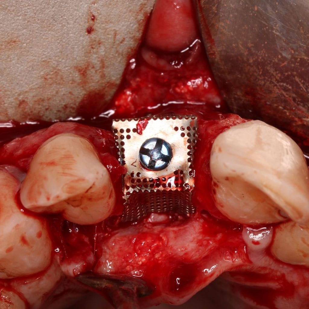 Tornillos para carpa DM – Bionnovation Biomedical, Bone Graft Materials