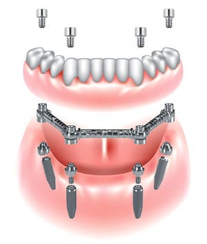 Dispositivo CAB – Clip Abutment Bar – BioSAF IN, Implantologie