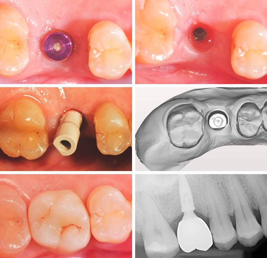 Impianti Torque Type – BioSAF IN, Implants