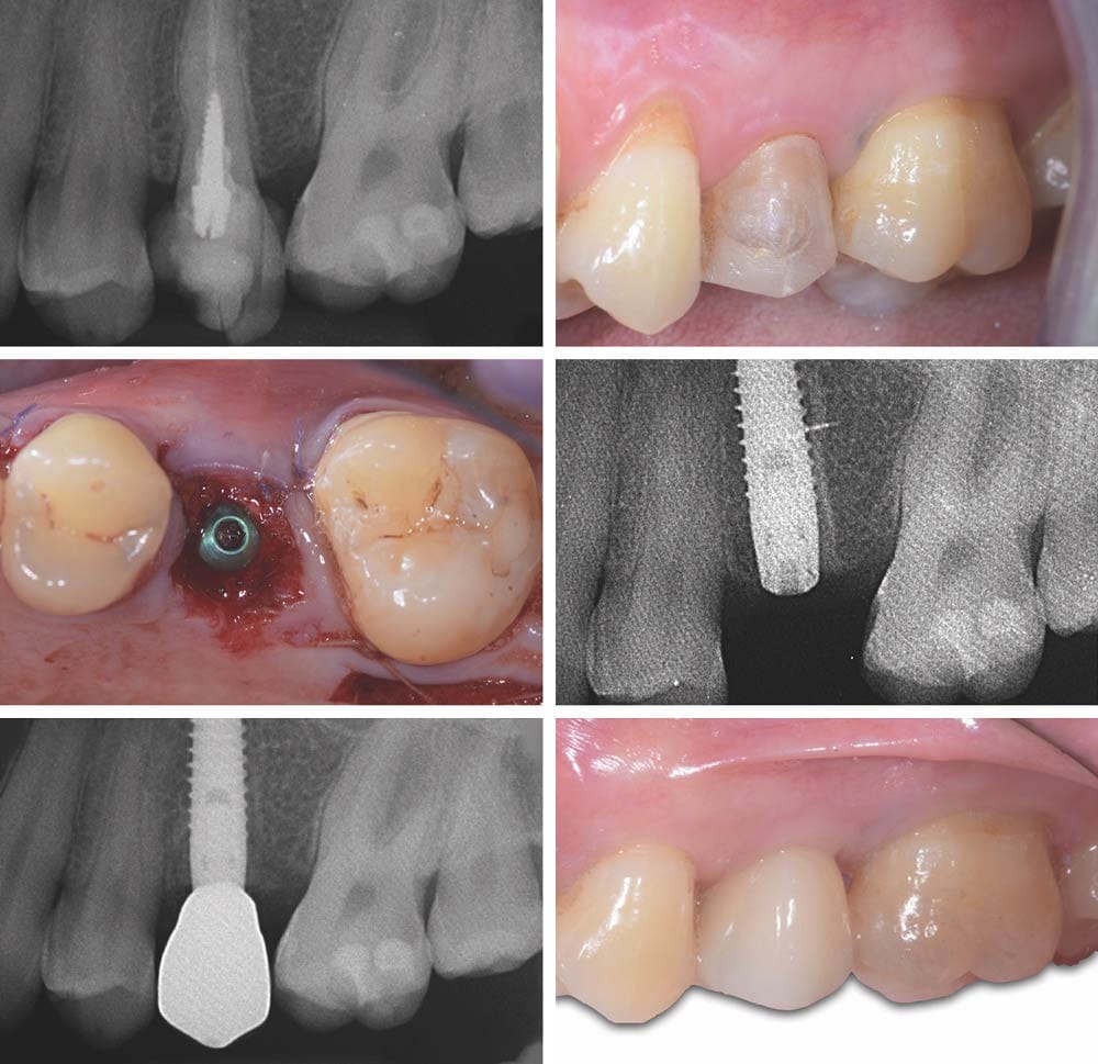 Impianti Linea KAPPA – BioSAF IN, Implants