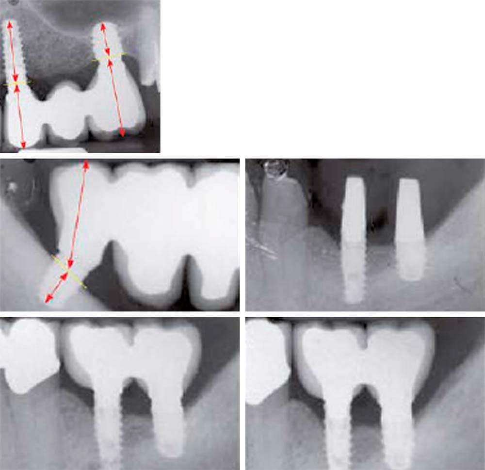 Impianti SHORT – BioSAF IN, Implants