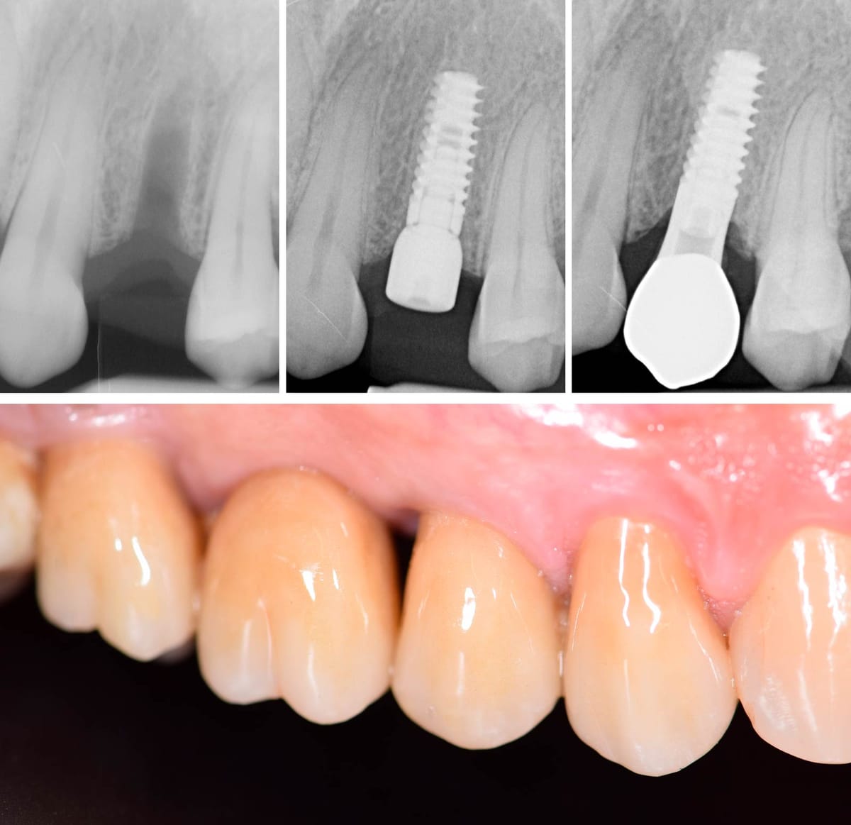 Impianti K25 – BioSAF IN, Implants