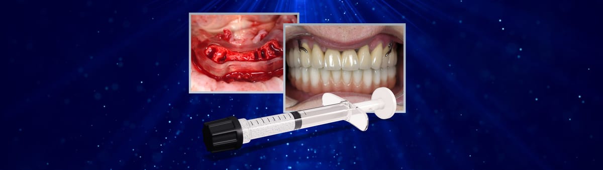 DSI Alyoss Plus Allograft – DSI Dental Solutions Ltd, Knochenersatzmaterial