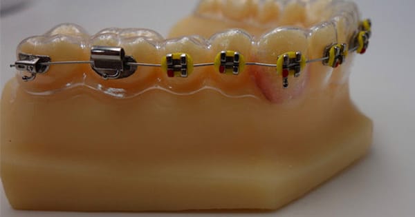 Clear Retainer with Brackets