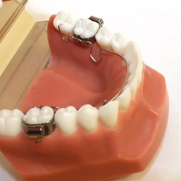 Wilson 3D Lingual Arch Pack of 3