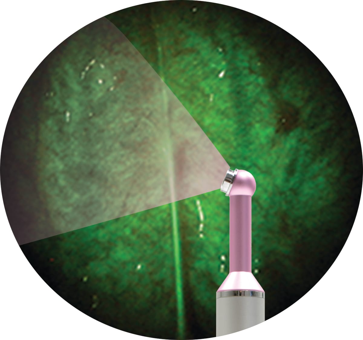 FUSION DOE - Oral Examination & Caries Detection Device – DentLight Inc., Intraoral Cameras