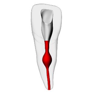 Incisor – Internal resorption, Radiopaque (White) | Dental Training Models | DRSK