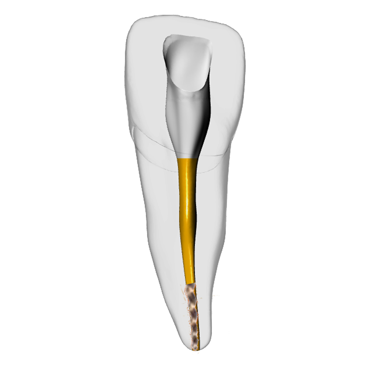 Incisor – Gutta percha, Broken file, White | Dental Training Models | DRSK
