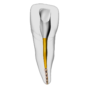 Incisor – Gutta percha, Broken file, Clear | Dental Training Models | DRSK