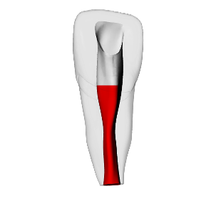 Incisor – Accessed, Open apex, Pulp | Dental Training Models | DRSK – DRSK Group AB, Gypsum Additives, Die Hardeners and Plaster Removers
