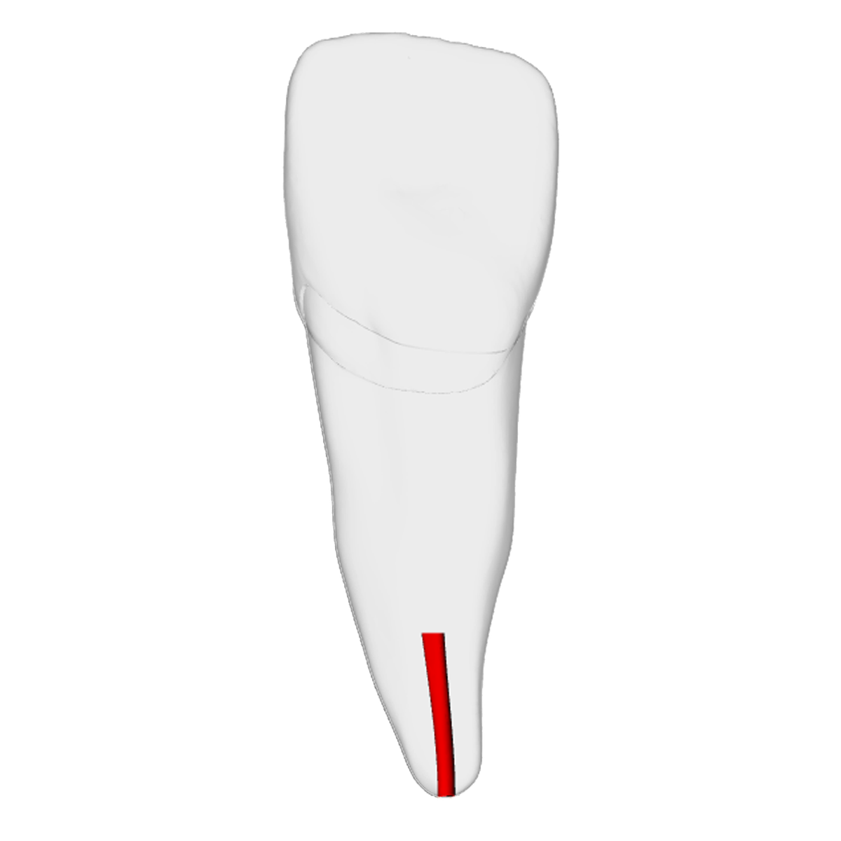 Incisor – Obliterated | Dental Training Models | DRSK – DRSK Group AB, Zubehör für Wurzelbehandlung