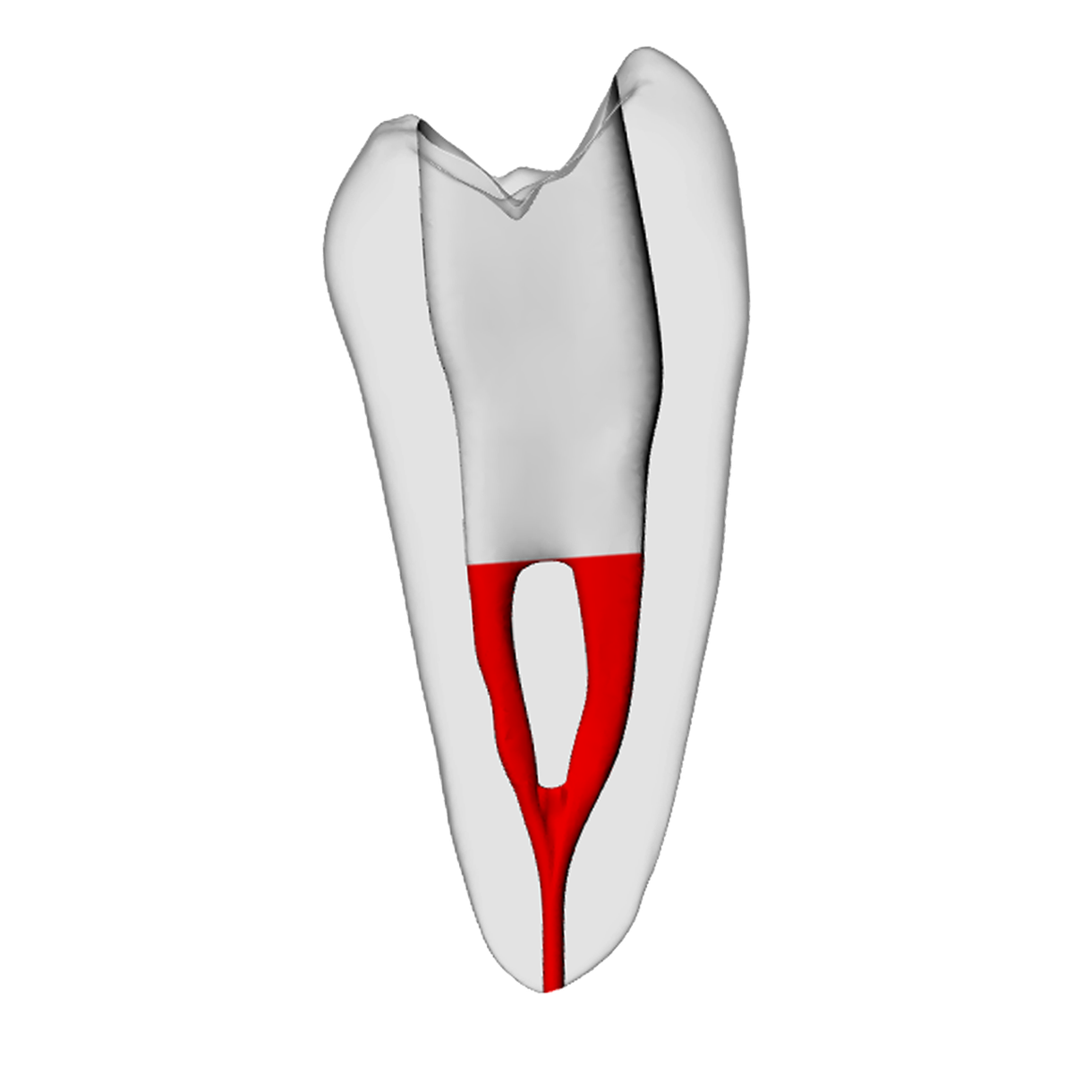 Premolar – Accessed, Merging canals, Radiopaque (White) | Dental Training Models | DRSK – DRSK Group AB, Zubehör für Wurzelbehandlung