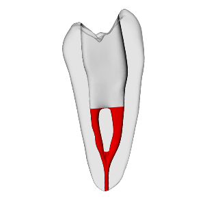 Premolar – Accessed, Merging canals, Clear, ~20# | Dental Training Models | DRSK