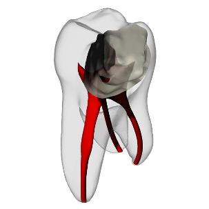 Molar – Pulp exposure, Clear | Dental Training Models | DRSK – DRSK Group AB