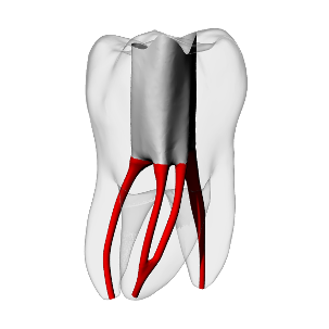 Molar – Accessed, Merging MB2, Clear, ~20# | Dental Training Models | DRSK – DRSK Group AB, Demomodelle