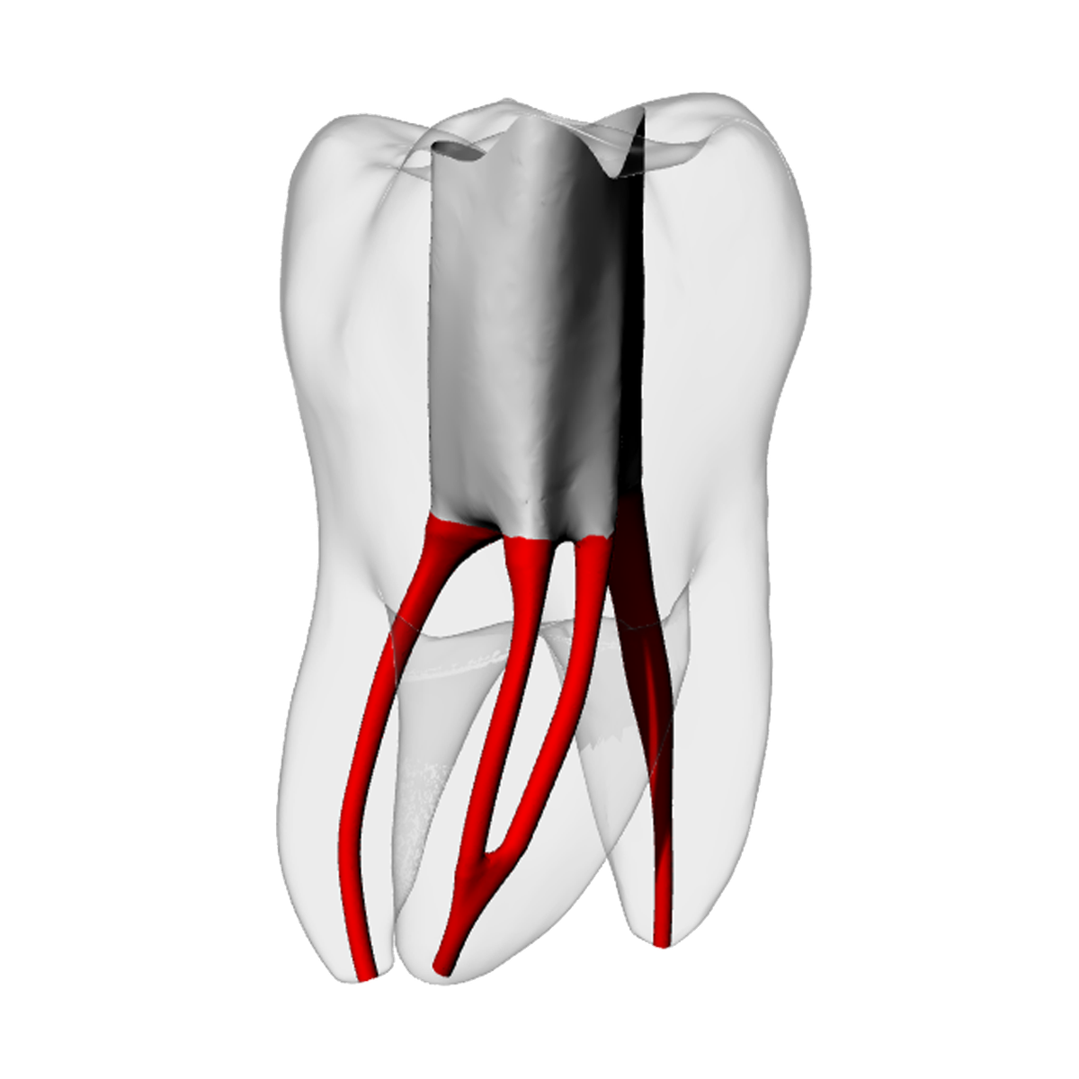 Molar – Accessed, Merging MB2, Radiopaque (White) | Dental Training Models | DRSK – DRSK Group AB, Demonstration Models