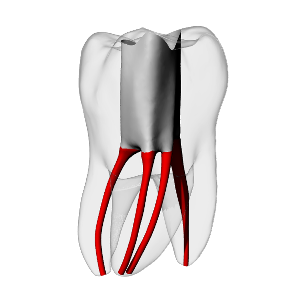 Molar – Accessed, MB2, Clear, ~20# | Dental Training Models | DRSK
