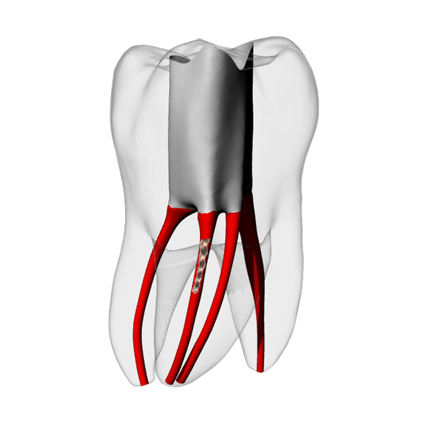 Molar – Broken file | Dental Training Models | DRSK