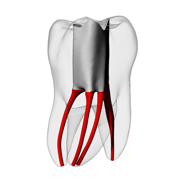 Molar – Accessed, MB2, Radiopaque (White) | Dental Training Models | DRSK