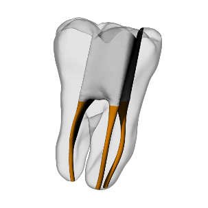 Molar – Accessed, Gutta percha, Clear | Dental Training Models | DRSK – DRSK Group AB, Zubehör für Wurzelbehandlung