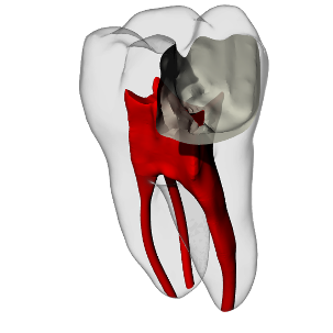 Molar – Pulp exposure, Carious lesion, Radiopaque (White) | Dental Training Models | DRSK