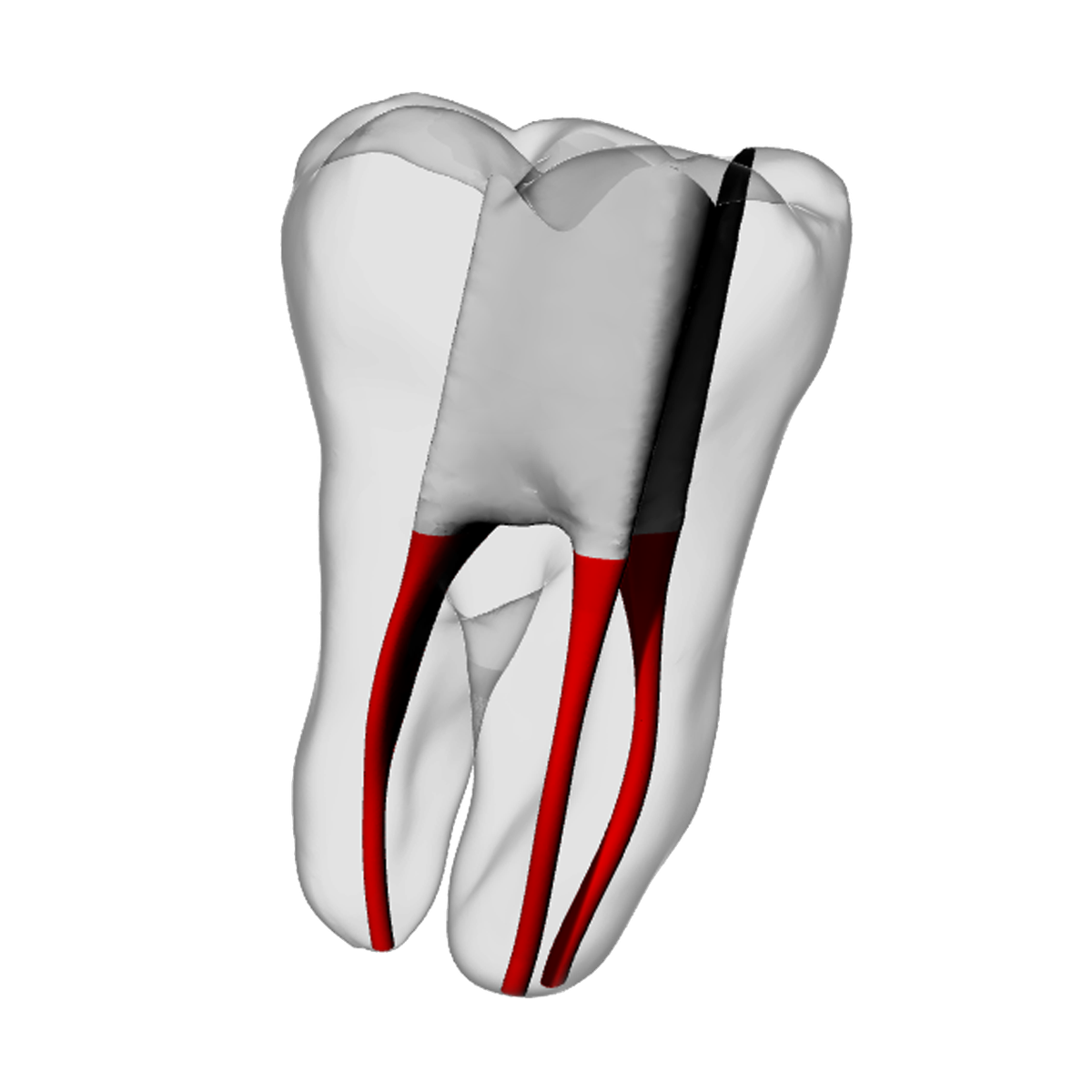 Molar – Accessed, Basic, Clear | Dental Training Models | DRSK – DRSK Group AB