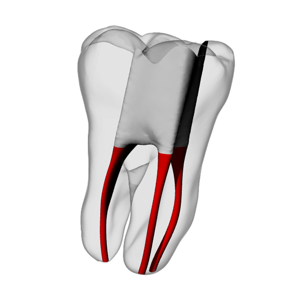 Molar – Accessed, Basic, Clear | Dental Training Models | DRSK