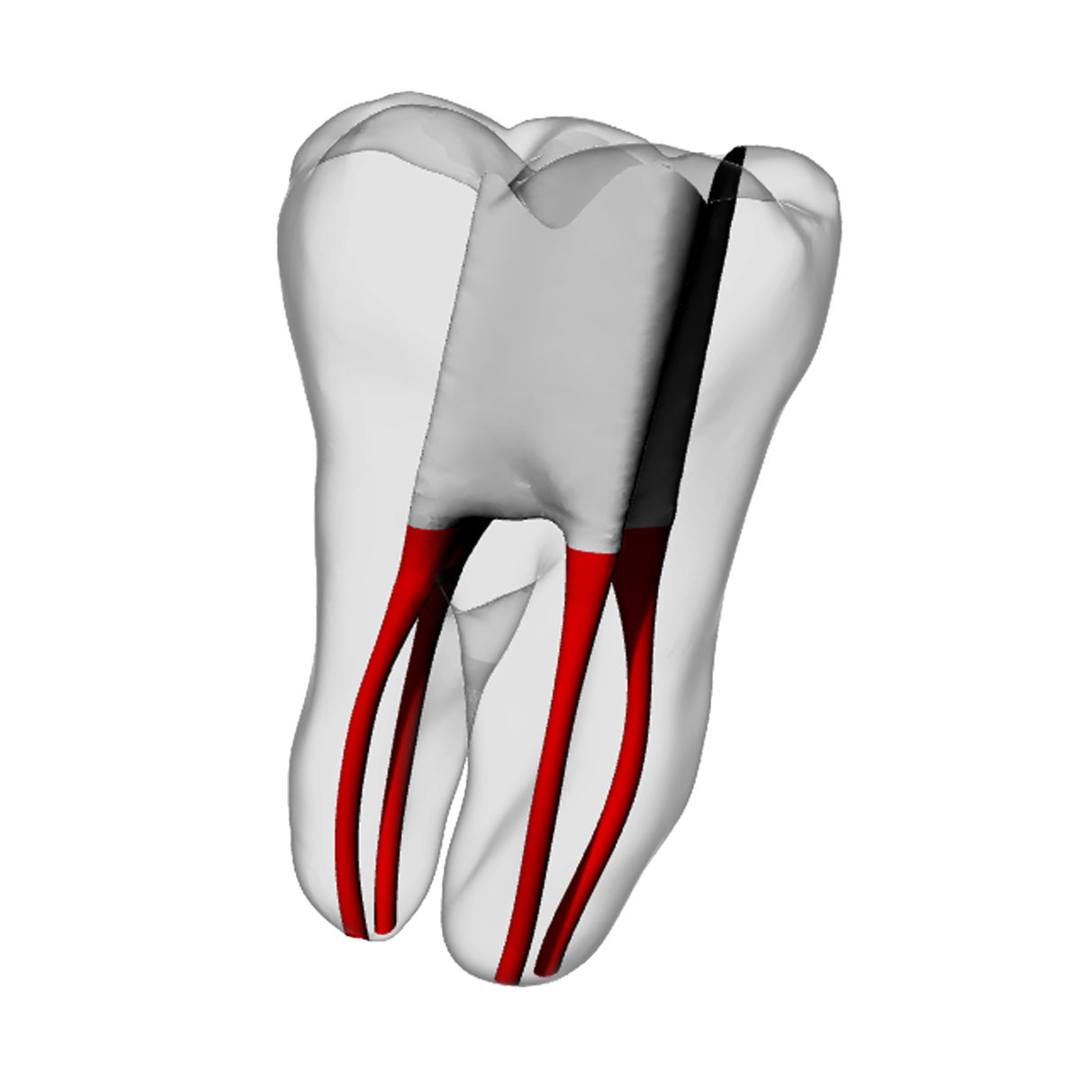 Molar – Accessed, Four canals, Clear | Dental Training Models | DRSK – DRSK Group AB, Demomodelle
