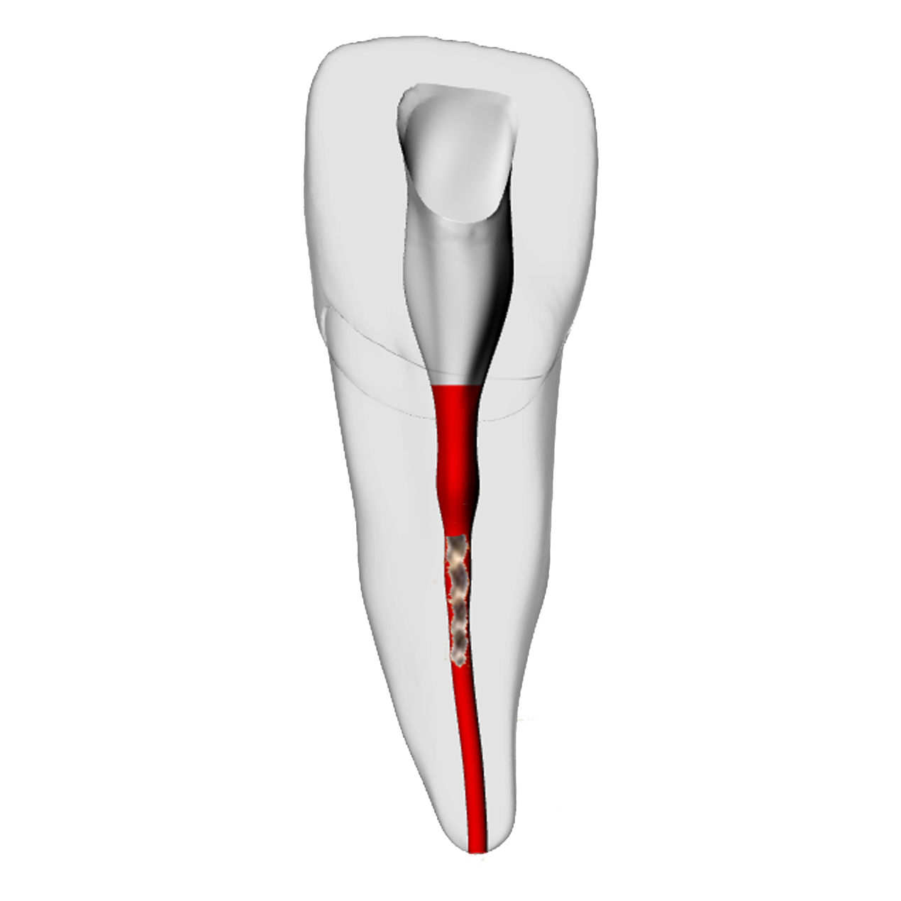 Incisor – Broken file | Dental Training Models | DRSK