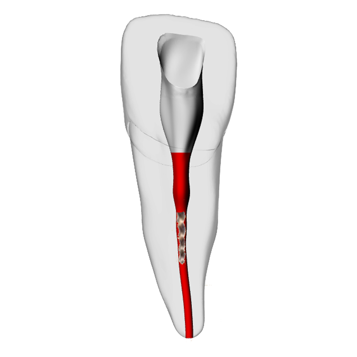 Incisor – Broken file | Dental Training Models | DRSK – DRSK Group AB, Gipszusätze, Stumpflacke und Gipslöser