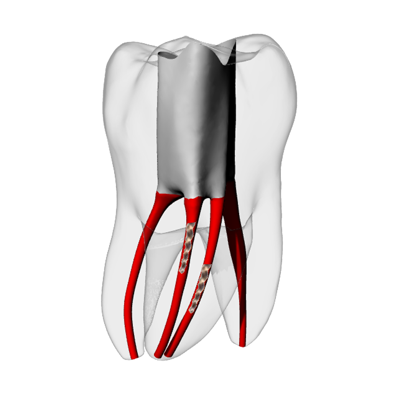 Molar – Two Broken files | Dental Training Models | DRSK